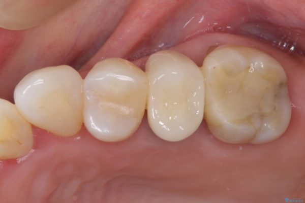 歯肉退縮で歯根が見えるようになってしまった　オールセラミッククラウンによる審美歯科治療 治療後画像
