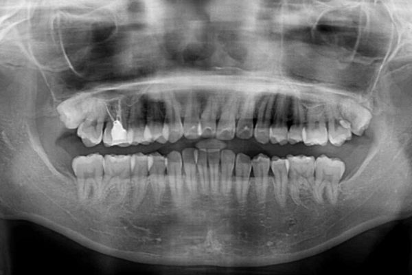 前歯の気になるデコボコをインビザラインで矯正治療 治療前画像