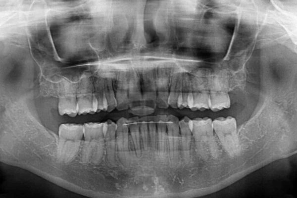 抜歯矯正の後戻り　インビザラインによる再矯正治療 治療後画像
