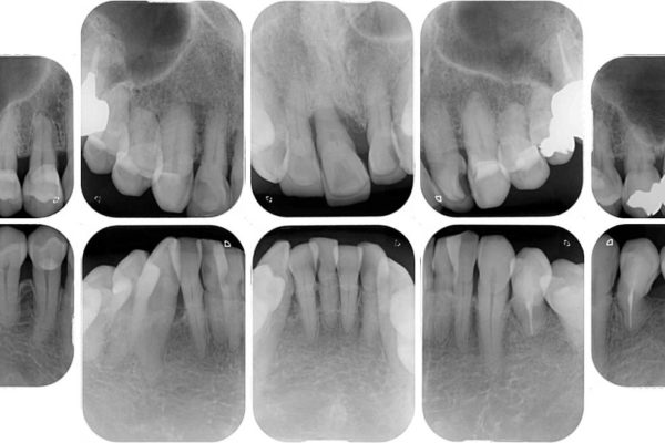 矯正治療と歯周外科処置を併用した審美歯科治療 治療前画像