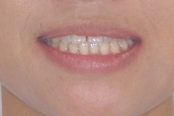 気になる前歯の隙間を短期間のワイヤー矯正で治療 治療前画像