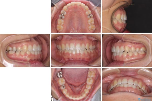 気になる前歯の隙間を短期間のワイヤー矯正で治療 治療後画像