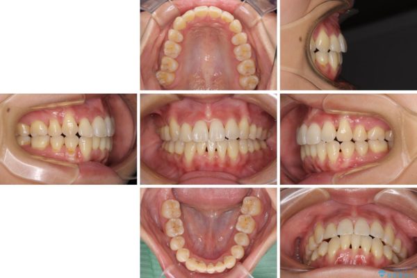前歯のデコボコを治したい　費用を抑えたメタルワイヤーでの抜歯矯正 治療後画像