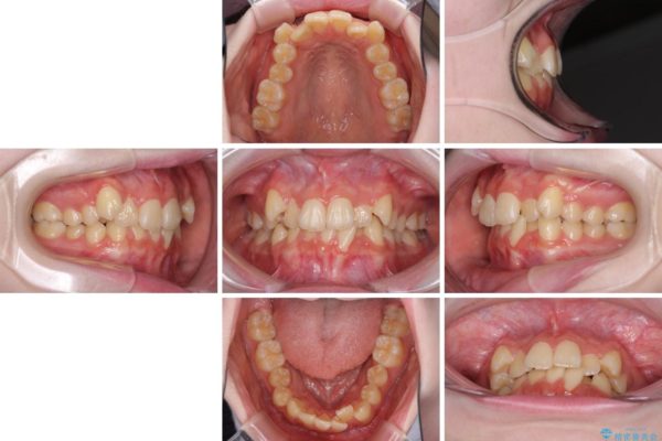 前歯のガタつきを治したい　非抜歯でのワイヤー矯正 治療前画像