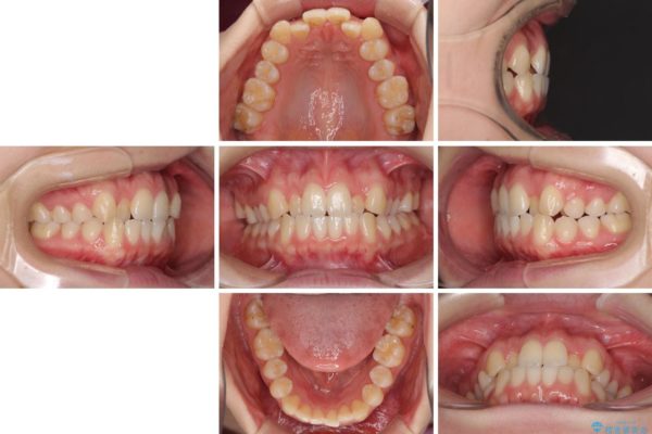 前歯の反対咬合をインビザライン矯正で改善 治療前画像