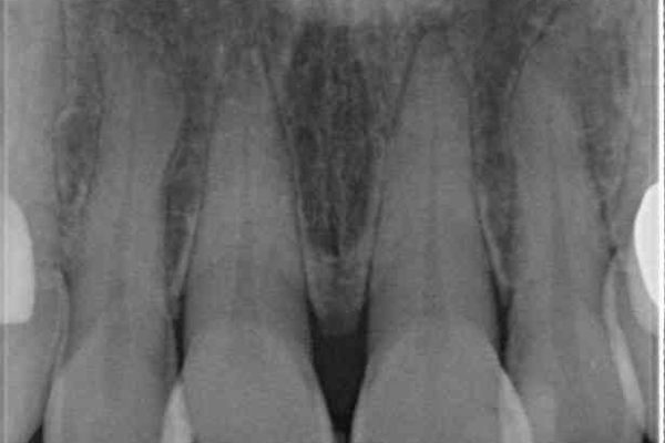 度重なる治療で前歯がしみる　オールセラミッククラウンによる補綴治療 治療前画像