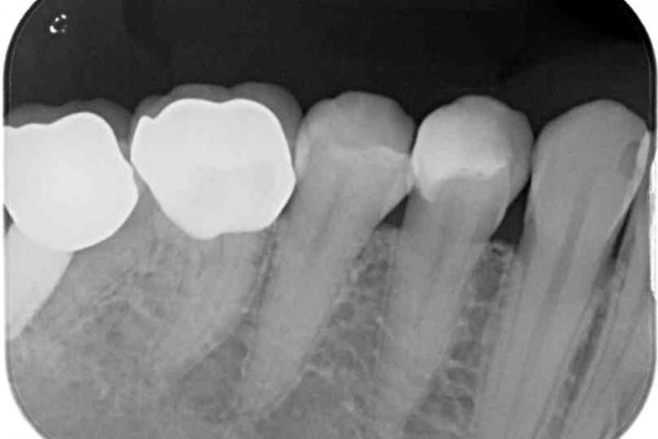 奥歯がしみる　セラミックインレーによるむし歯治療 治療前画像