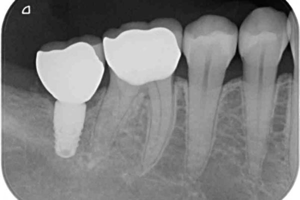 奥歯がしみる　セラミックインレーによるむし歯治療 治療後画像
