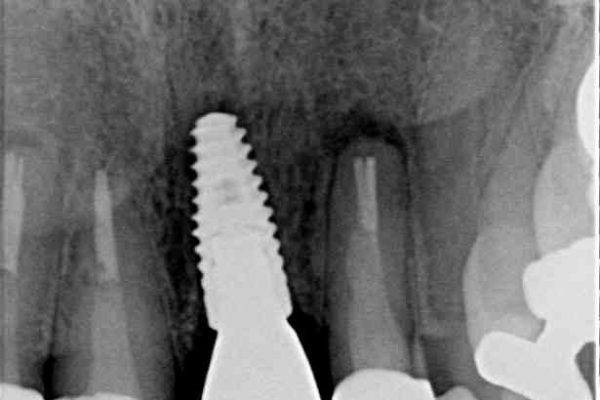 前歯が折れてしまった　インプラントによる補綴治療 治療後画像