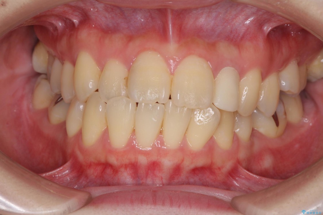 話しにくい歯並びの改善　抜歯矯正治療と前歯の審美治療 治療前