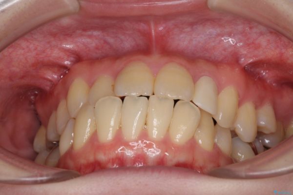 話しにくい歯並びの改善　抜歯矯正治療と前歯の審美治療 治療前画像