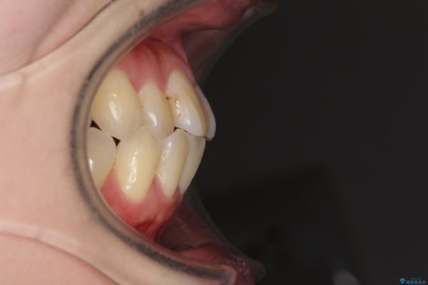 話しにくい歯並びの改善　抜歯矯正治療と前歯の審美治療 治療前画像