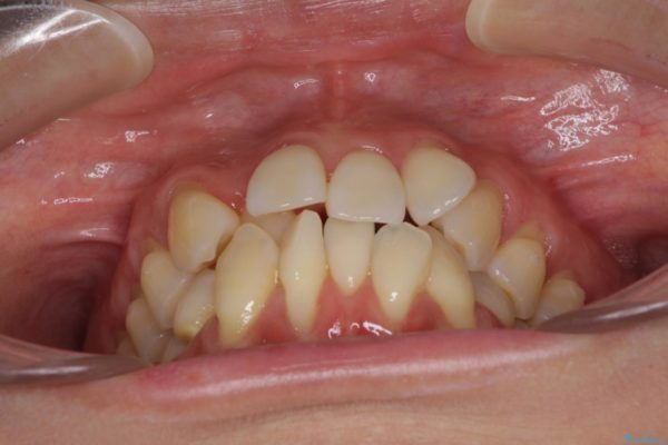 前歯のデコボコを治したい　費用を抑えたメタルワイヤーでの抜歯矯正 治療前画像