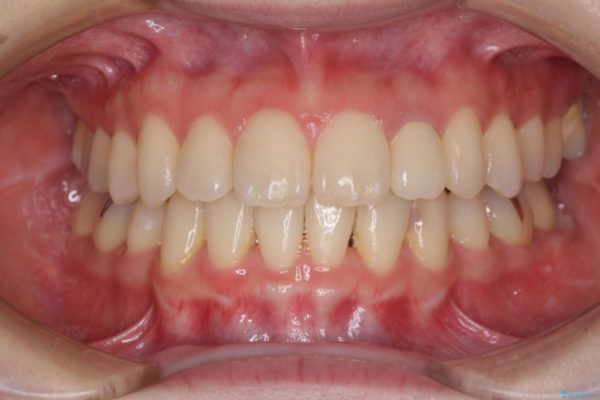 話しにくい歯並びの改善　抜歯矯正治療と前歯の審美治療 治療後画像