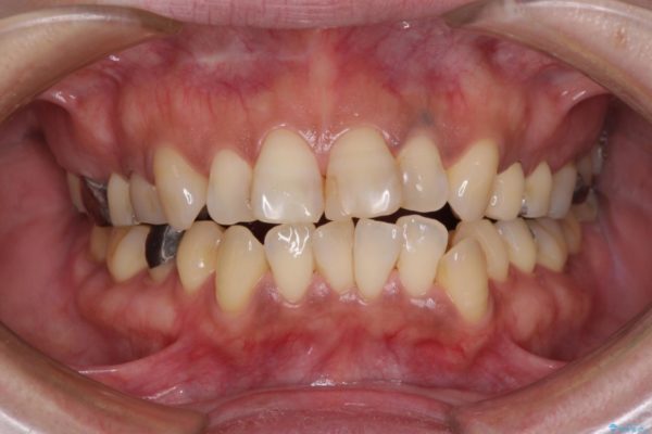 度重なる治療で前歯がしみる　オールセラミッククラウンによる補綴治療 治療前画像