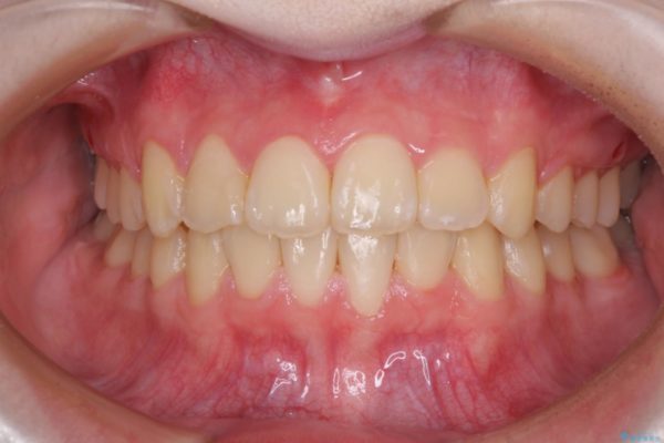 前歯のガタつきを治したい　非抜歯でのワイヤー矯正 治療後画像