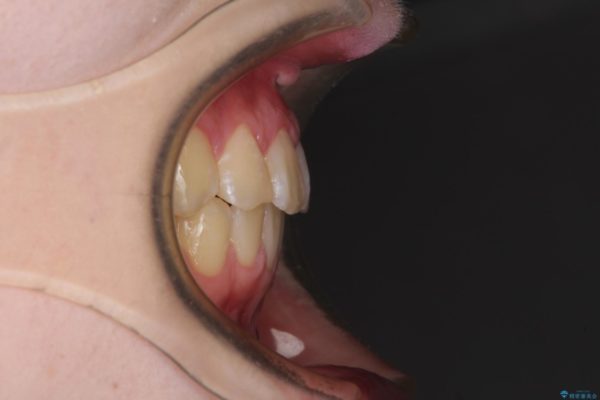 前歯のガタつきを治したい　非抜歯でのワイヤー矯正 治療後画像