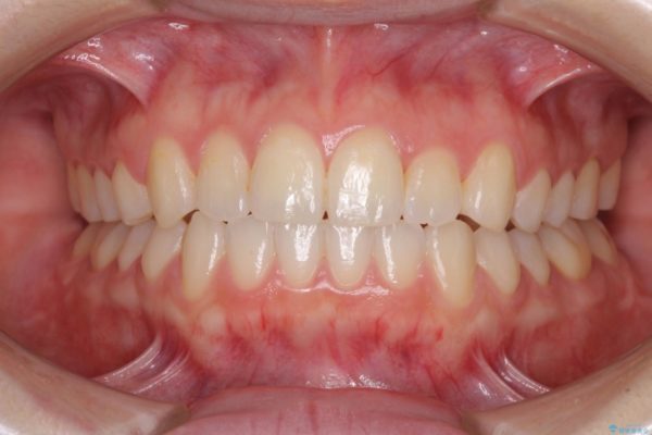 前歯の反対咬合をインビザライン矯正で改善 治療後画像