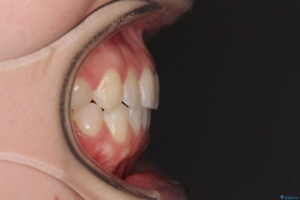 前歯の反対咬合をインビザライン矯正で改善 治療後画像