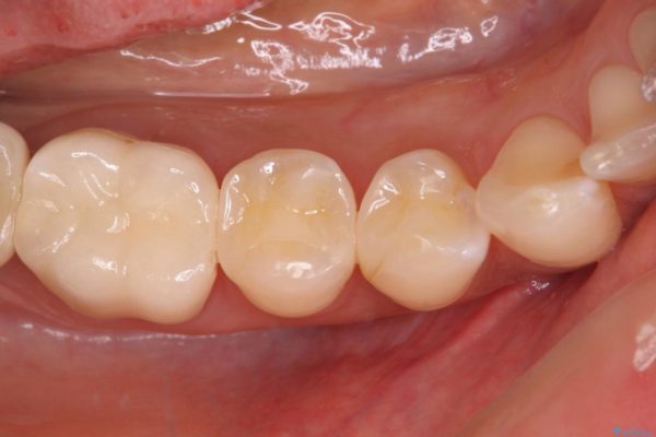 奥歯がしみる　セラミックインレーによるむし歯治療 治療後画像