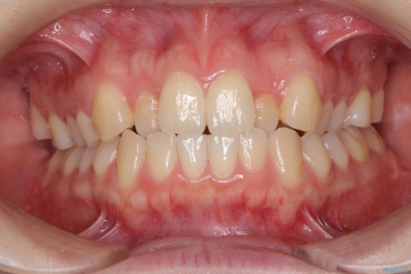 前歯の反対咬合をインビザライン矯正で改善 治療前画像
