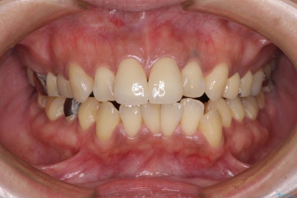 度重なる治療で前歯がしみる　オールセラミッククラウンによる補綴治療 治療後画像