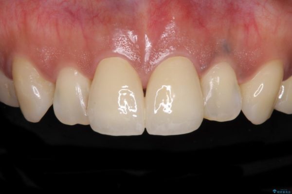 度重なる治療で前歯がしみる　オールセラミッククラウンによる補綴治療 治療後画像