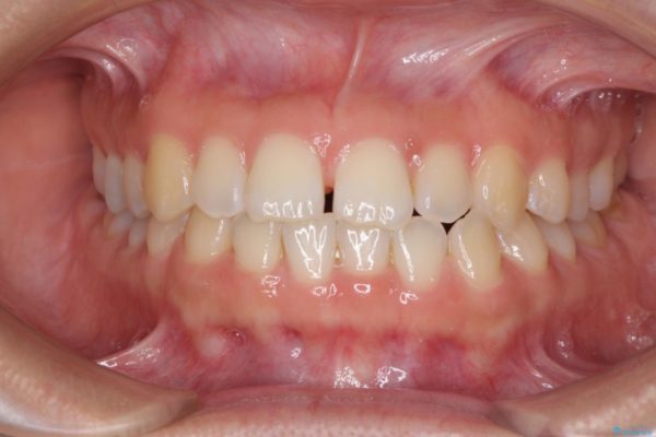 気になる前歯の隙間を短期間のワイヤー矯正で治療 治療前画像