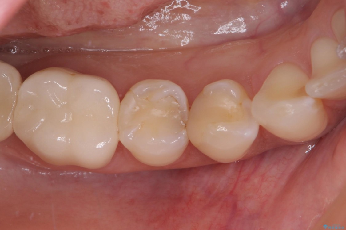 奥歯がしみる　セラミックインレーによるむし歯治療 治療前