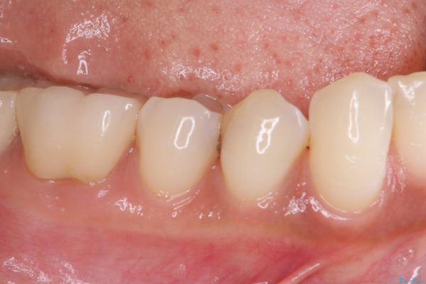 奥歯がしみる　セラミックインレーによるむし歯治療 治療前画像