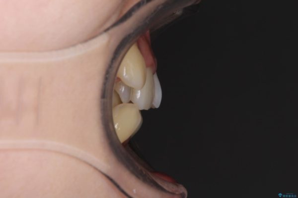 結婚式までに口元を変えたい　ワイヤー装置での抜歯矯正 治療前画像