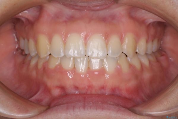 気になる前歯の隙間を短期間のワイヤー矯正で治療 アフター