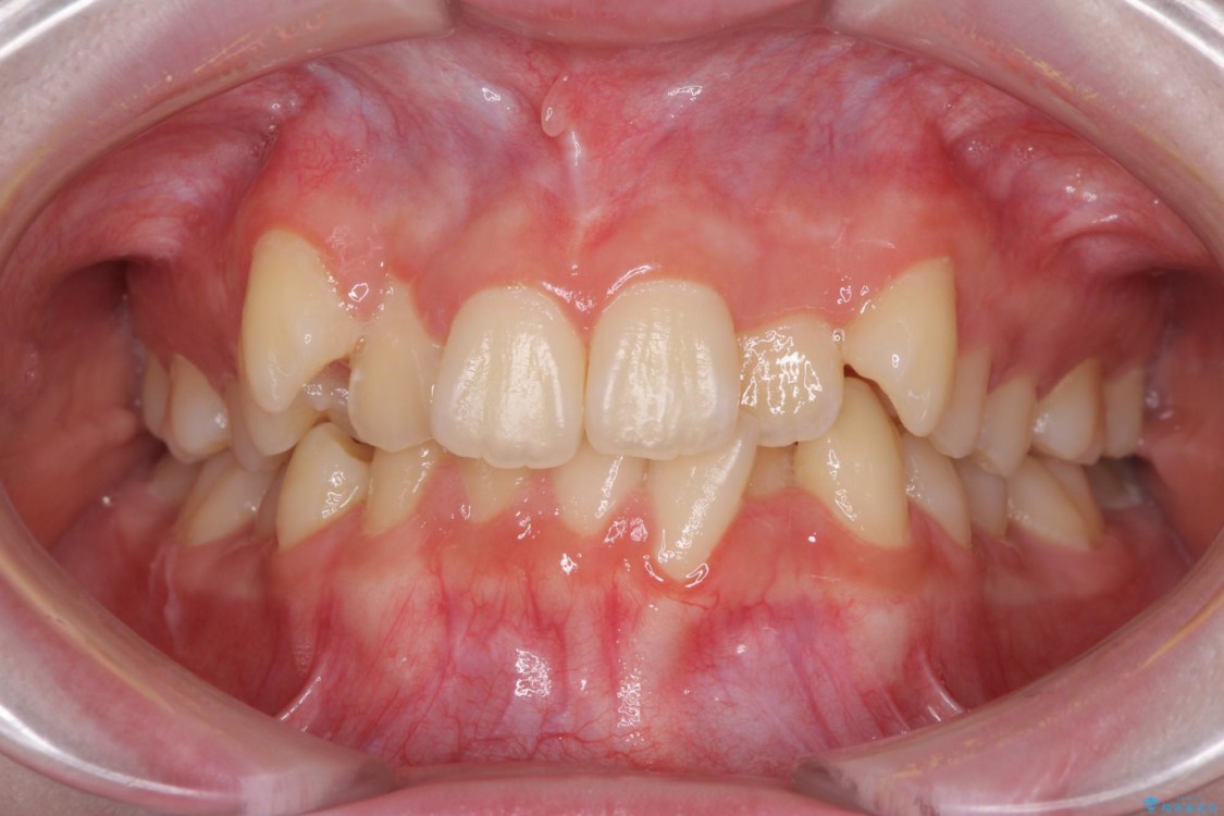 前歯のガタつきを治したい　非抜歯でのワイヤー矯正 治療前