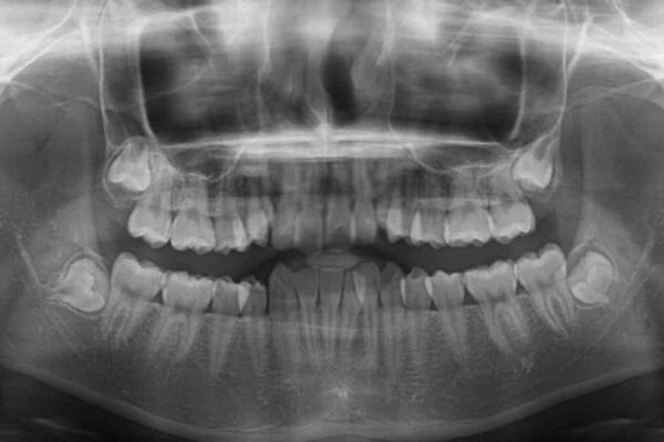 前歯のガタつきを治したい　非抜歯でのワイヤー矯正 治療前画像