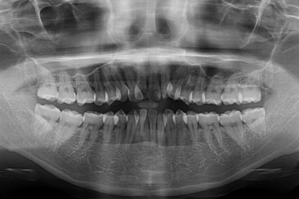 前歯のデコボコを治したい　費用を抑えたメタルワイヤーでの抜歯矯正 治療前画像