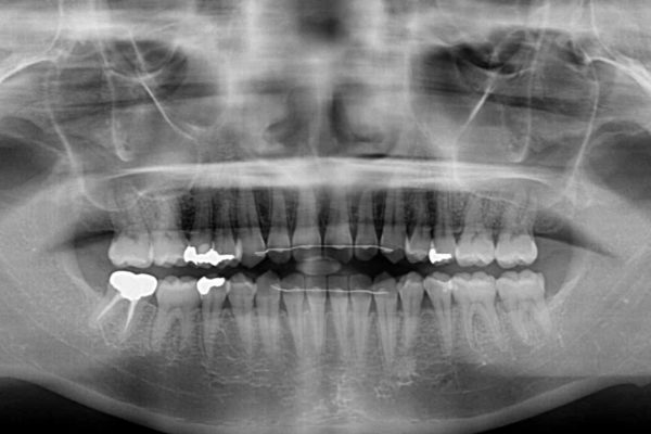 気になる前歯の隙間を短期間のワイヤー矯正で治療 治療後画像