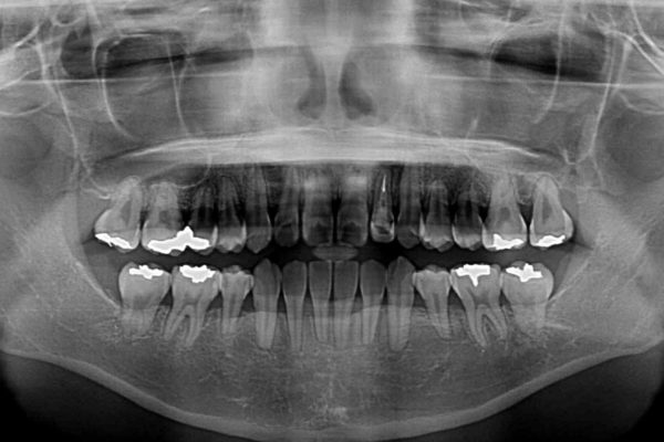 話しにくい歯並びの改善　抜歯矯正治療と前歯の審美治療 治療後画像