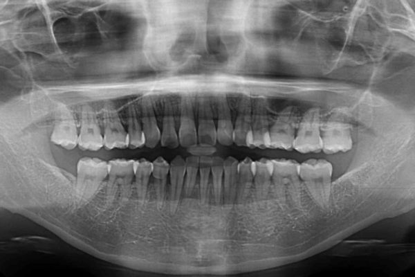 前歯のデコボコを治したい　費用を抑えたメタルワイヤーでの抜歯矯正 治療後画像