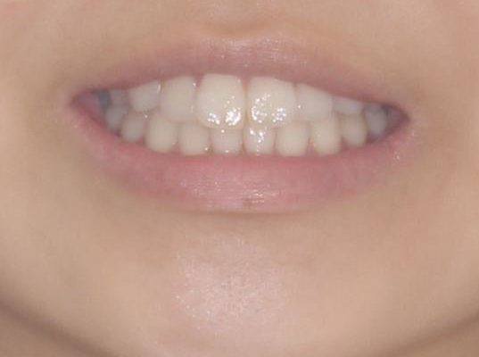 気になる前歯を整えたい　インビザライン・ライトでの矯正治療 治療前画像