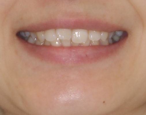 倒れた奥歯を改善　インビザラインでの矯正治療 治療前画像