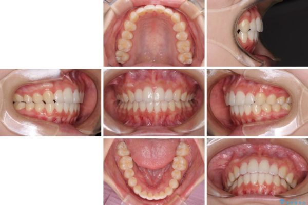 前歯のデコボコと突出感を改善したい　インビザラインによる矯正治療 治療後画像