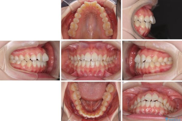 インビザラインで気になる前歯を綺麗に整える 治療前画像