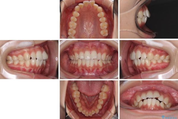 前歯のデコボコと突出感を改善したい　インビザラインによる矯正治療 治療前画像