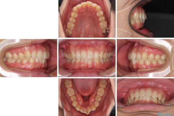 前歯の咬み合わせとデコボコを解消　インビザラインによる矯正治療 治療前画像