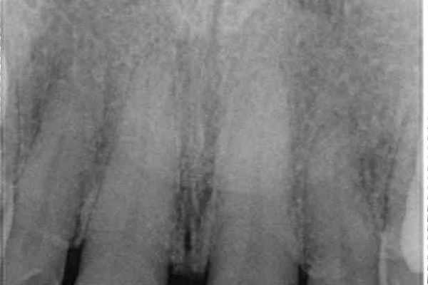 前歯の隙間を閉じたい　ラミネートベニアによる審美歯科治療 治療前画像