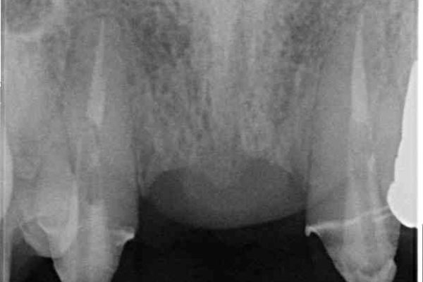 他院で入れた仮歯が不快　当院で使用感の良いオールセラミックブリッジに 治療前画像
