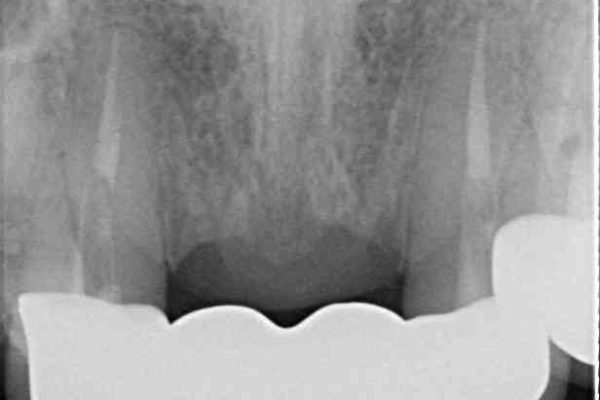 他院で入れた仮歯が不快　当院で使用感の良いオールセラミックブリッジに 治療後画像