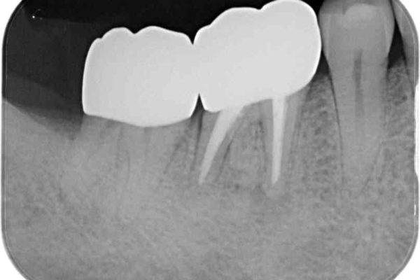 骨の中にまで及んだ深い虫歯　歯周外科処置を用いた補綴治療 治療後画像