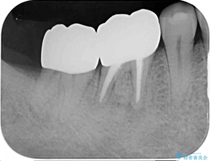 骨の中にまで及んだ深い虫歯　歯周外科処置を用いた補綴治療 アフター