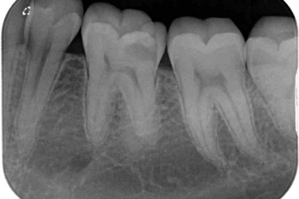神経近くにまで及んだ大きなむし歯のセラミッククラウン 治療前画像